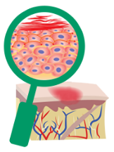 A close up look of skin cells in patients with Uncontrolled Moderate-to-Severe Eczema (Atopic Dermatitis)