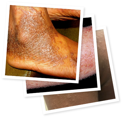 Pictures of moderate-to-severe eczema on various skin tones and different body parts