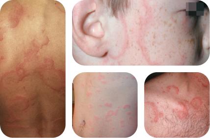 How chronic spontaneous urticaria (CSU), also known as chronic hives with no known cause can look on various body parts on light, white, pale, fair skin