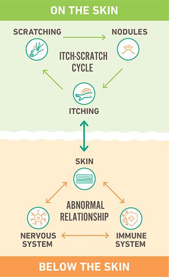 Diagram of how prurigo nodularis works below the skin and on the skin