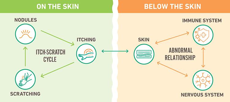 Diagram of prurigo nodularis below the skin and on the skin