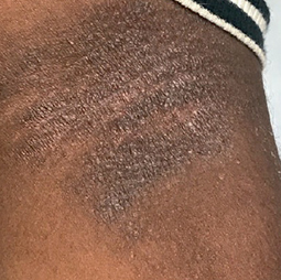 Moderate-to-Severe eczema on dark, brown, black skin on arm