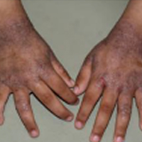 Moderate-to-Severe eczema on dark, brown, black skin on hands