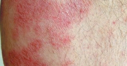 Moderate-to-Severe eczema on light, white, pale, fair skin on leg