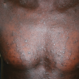Moderate-to-Severe eczema on dark, brown, black skin on chest