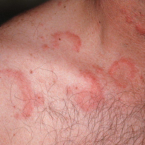 chronic spontaneous urticaria, also known as chronic hives with no known cause on light, white, pale, fair skin on a chest