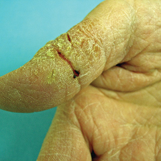 Moderate-to-Severe eczema on light, white, pale, fair skin on hand
