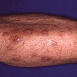 Prurigo Nodularis (PN) on a patient's leg who is not on DUPIXENT® (dupilumab)