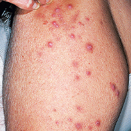 Prurigo nodularis (PN) on a patient's arm who is not on DUPIXENT® (dupilumab)