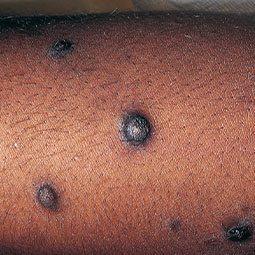 Prurigo nodularis (PN) nodule on a patient's arm who is not on DUPIXENT® (dupilumab)