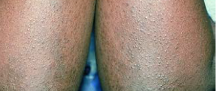 Moderate-to-Severe eczema on dark, brown, black skin on arms