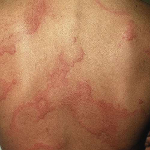 chronic spontaneous urticaria, also known as chronic hives with no known cause on light, white, pale, fair skin on the back