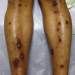 Prurigo nodularis (PN) bumps on a patient's legs who is not on DUPIXENT® (dupilumab)