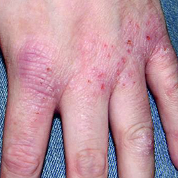 Moderate-to-Severe eczema on light, white, pale, fair skin on hand