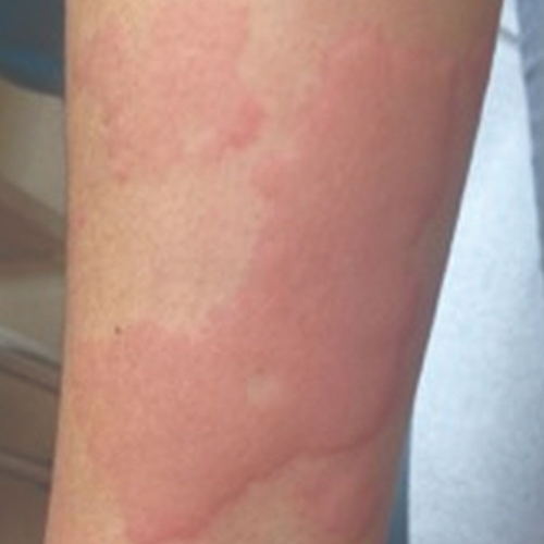 chronic spontaneous urticaria, also known as chronic hives with no known cause on light, white, pale, fair skin on an arm