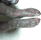 Moderate-to-Severe eczema on dark, brown, black skin on feet & ankles