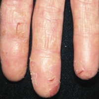 Moderate-to-Severe eczema on light, white, pale, fair skin on fingers