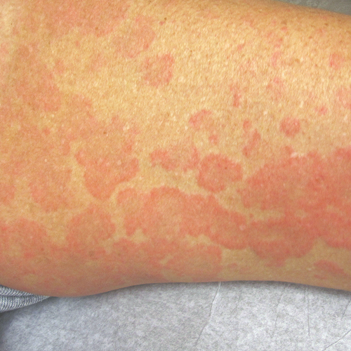 chronic spontaneous urticaria, also known as chronic hives with no known cause on light, white, pale, fair skin on an arm
