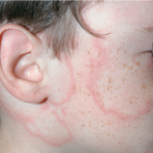 chronic spontaneous urticaria, also known as chronic hives with no known cause  on light, white, pale, fair skin on face