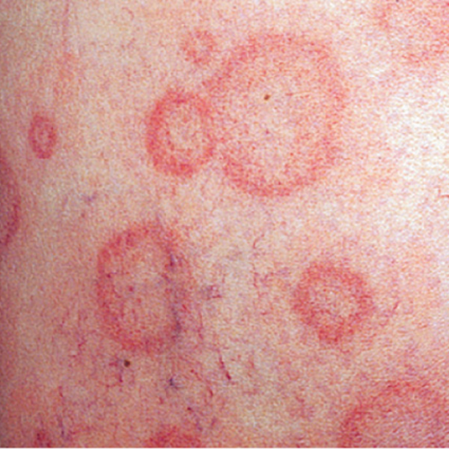 chronic spontaneous urticaria, also known as chronic hives with no known cause on light, white, pale, fair skin