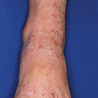 Moderate-to-Severe eczema on light, white, pale, fair skin on foot & ankle
