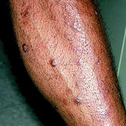 Prurigo nodularis (PN) on a patient's leg who is not on DUPIXENT® (dupilumab)