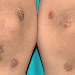 Prurigo nodularis (PN) on a patient's legs who is not on DUPIXENT® (dupilumab)