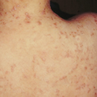 Moderate-to-Severe eczema on light, white, pale, fair skin on back