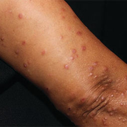 Prurigo nodularis (PN) bumps on a patient's arm who is not on DUPIXENT® (dupilumab)