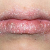 Moderate-to-Severe eczema on light, white, pale, fair skin on lips