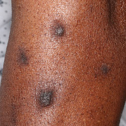 Prurigo nodularis (PN) on a patient's arm who is not on DUPIXENT® (dupilumab)