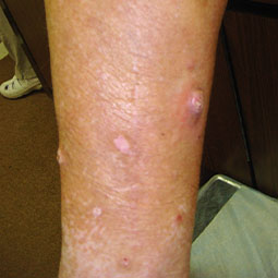 Prurigo nodularis (PN) on a patient's legs who is not on DUPIXENT® (dupilumab)