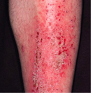 Moderate-to-Severe eczema on light, white, pale, fair skin on leg