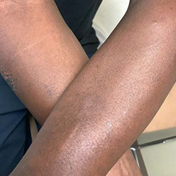 Moderate-to-Severe eczema on dark, brown, black skin on arms