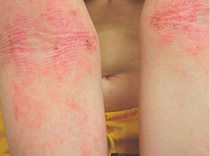 Moderate-to-Severe eczema on light, white, pale, fair skin on arm