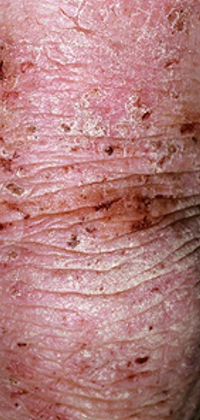 Atopic dermatitis patterns of inflammation. Lichenification with accentuation of normal skin lines. This lichenified plaque is surrounded by papules