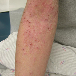 Moderate-to-Severe eczema on light, white, pale, fair skin on arm