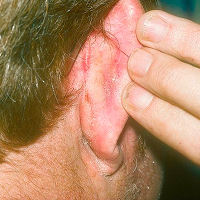 Moderate-to-Severe eczema on light, white, pale, fair skin behind ears