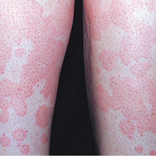chronic spontaneous urticaria, also known as chronic hives with no known cause on light, white, pale, fair skin on a leg