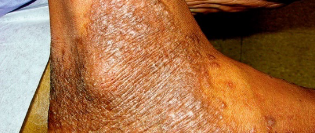 Moderate-to-Severe eczema on dark, brown, black skin on ankle