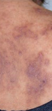 Moderate-to-Severe eczema on light, white, pale, fair skin on upper back