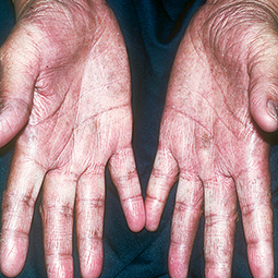 Moderate-to-Severe eczema on dark, brown, black skin on hands