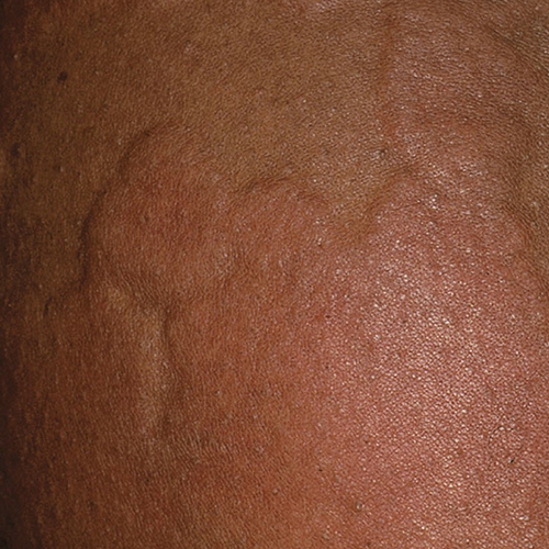 chronic spontaneous urticaria, also known as chronic hives with no known cause on dark, brown, black skin 