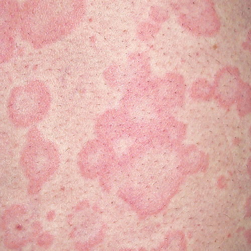 chronic spontaneous urticaria, also known as chronic hives with no known cause on light, white, pale, fair skin