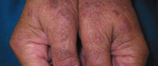Moderate-to-Severe eczema on dark, brown, black skin on hands
