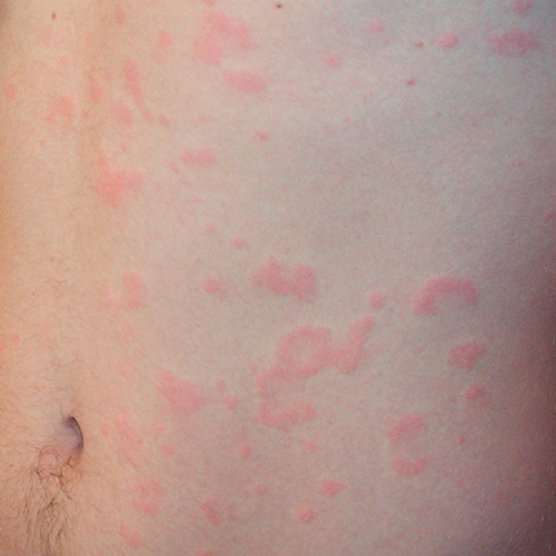 chronic spontaneous urticaria, also known as chronic hives with no known cause on light, white, pale, fair skin on a torso