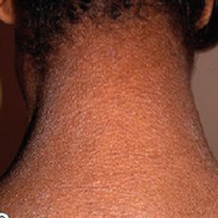 Moderate-to-Severe eczema on dark, brown, black skin on neck